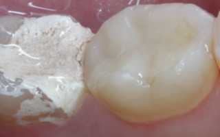 Сколько может находиться мышьяк в зубе