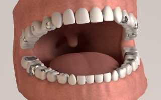 Амальгама в стоматологии