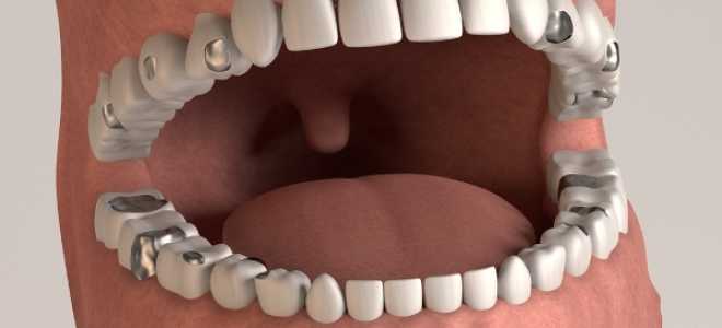 Амальгама в стоматологии