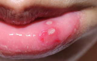 Болячки на губах с внутренней стороны и снаружи