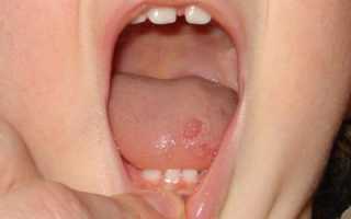 Стоматит на языке у ребенка