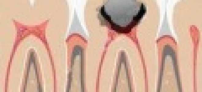 Кариес и гингивит