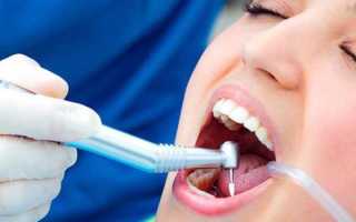 Сколько держится временная пломба в зубе