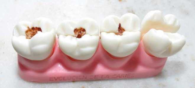 Причины возникновения и стадии развития кариеса зубов