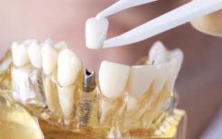 Как устанавливают металлокерамическую коронку на зуб