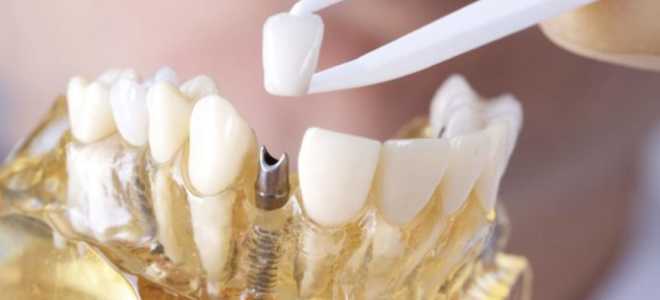 Видео как ставят коронку на зуб