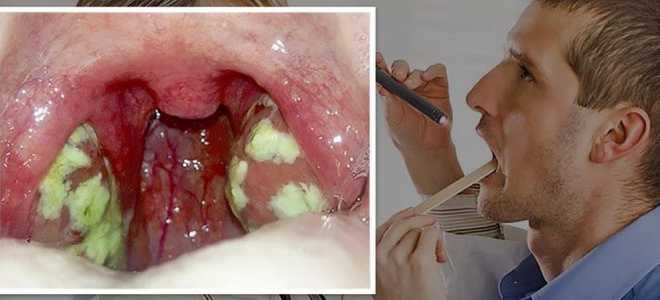 Белый налет в горле на миндалинах и гландах
