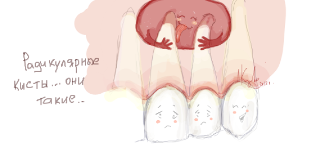 Киста на корне зуба как лечить