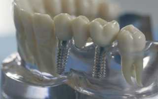Виды зубных протезов и мостов