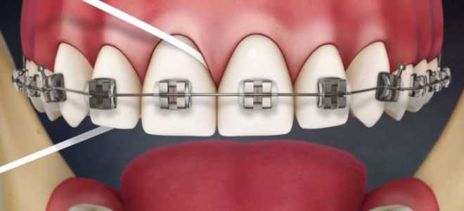 Зубная нить для брекетов