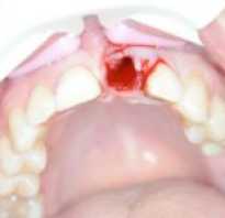 Как остановить кровь при удалении зуба