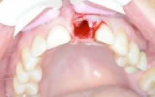Как остановить кровь при удалении зуба