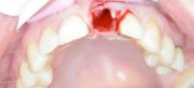 Как остановить кровь при удалении зуба