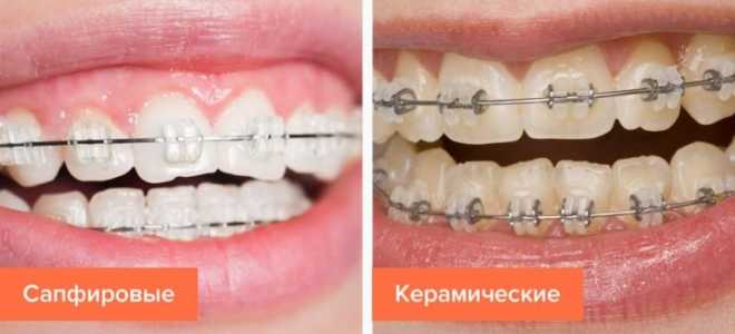 Керамические и сапфировые брекеты