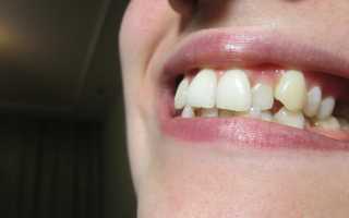 Ортодонтия перекрестный прикус
