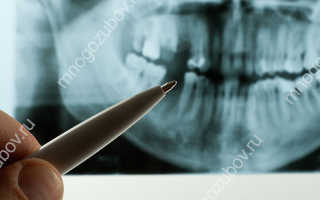 Сколько раз можно делать рентген зубов