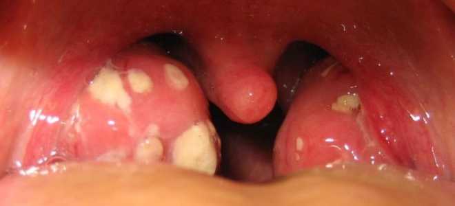 Гнойники на миндалинах как лечить