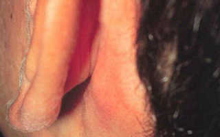 Воспаление возле уха