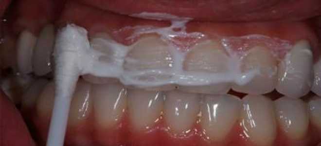 Удаление зубного камня в домашних условиях народными средствами