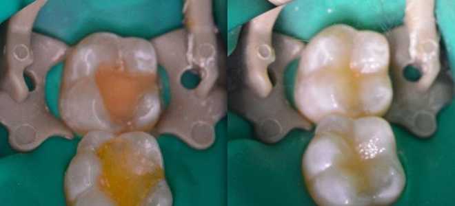 Световая пломба для зубов