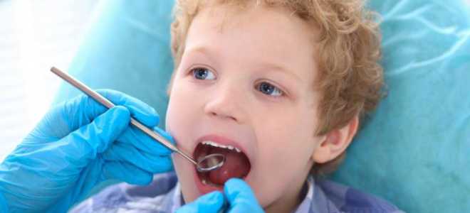 Герметизация фиссур у детей что это