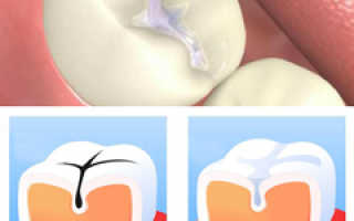 Как лечат кариес зубов
