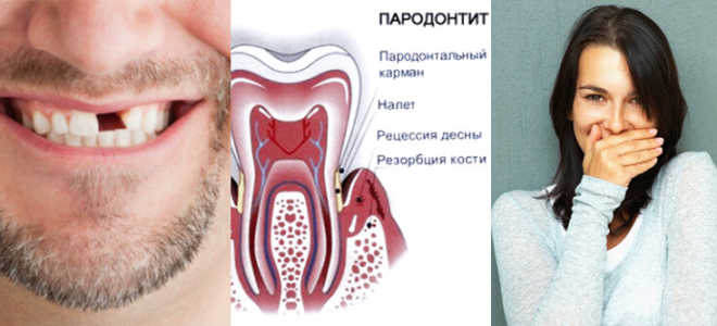 Последствия неправильного прикуса у взрослых