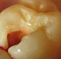 Болит зуб без нерва