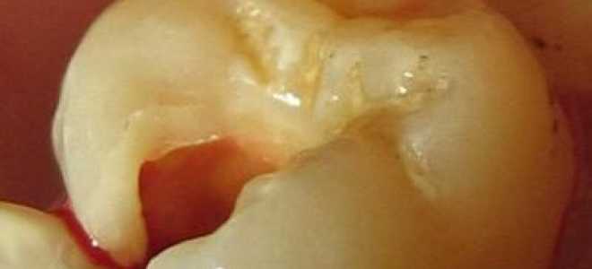 Болит зуб без нерва