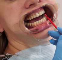 Покрытие зубов фторлаком