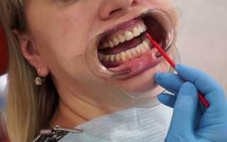 Покрытие зубов фторлаком