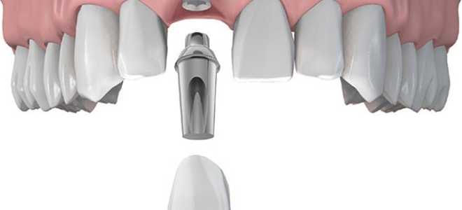 Что такое абатмент