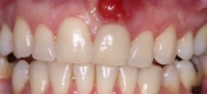 Свищ молочного зуба