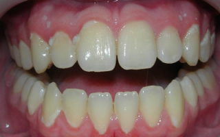 Белый налет на зубах около десен