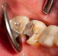 Сколько можно держать мышьяк в зубе ребенку