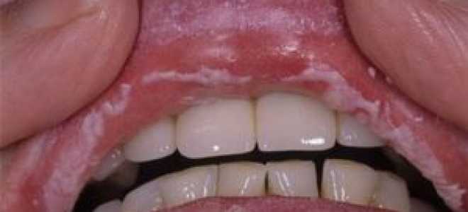 Грибы во рту лечение