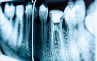 Гранулема зуба симптомы