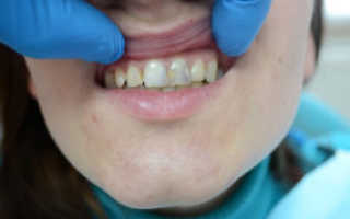 Причины крошения зубов