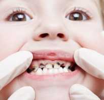 Серебрение зубов у детей