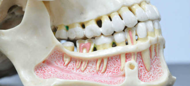 Остеомиелит нижней и верхней челюсти