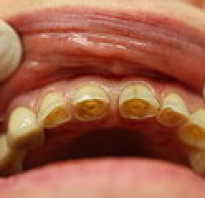 Стираемость зубов лечение