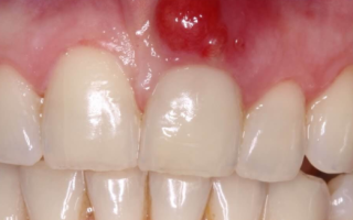 Киста в десне зуба симптомы