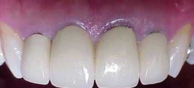 Срок службы металлокерамических коронок