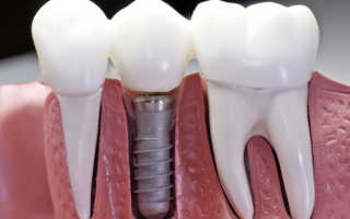 Как вставить зубные импланты