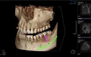 Компьютерная томография зубов в стоматологии