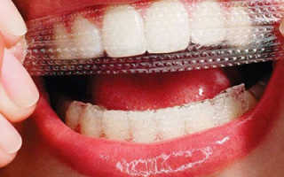 Чем лучше отбелить зубы в домашних условиях