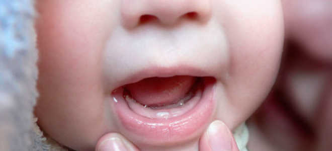 Как лечить стоматит у грудничков