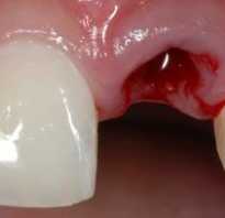 Сколько болит десна после удаления зуба