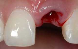 Сколько болит десна после удаления зуба