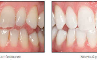 Домашнее отбеливание зубов с капами